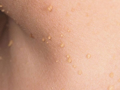 Treatment for skin tags, milk spots