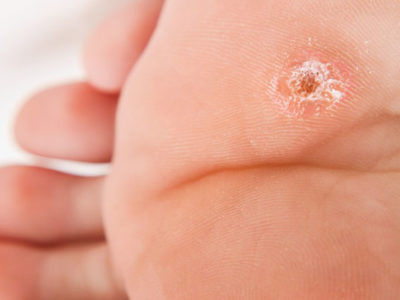 treatments for warts on foot